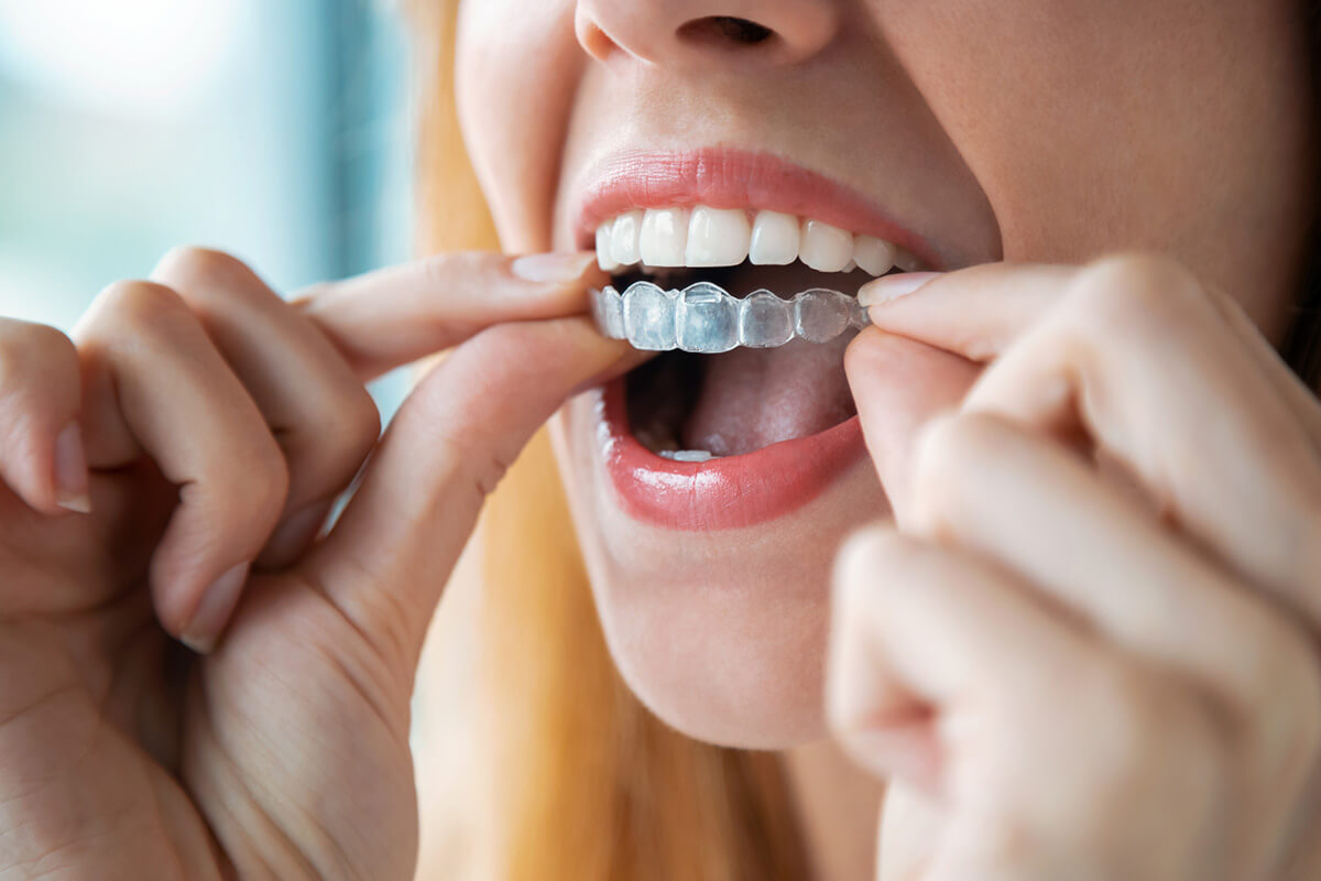 Can You Eat With Invisalign? Minoli & Vijay, DDS PC