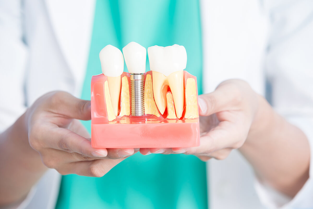 A Primer on the Dental Implant Procedure Upper East Side NYC
