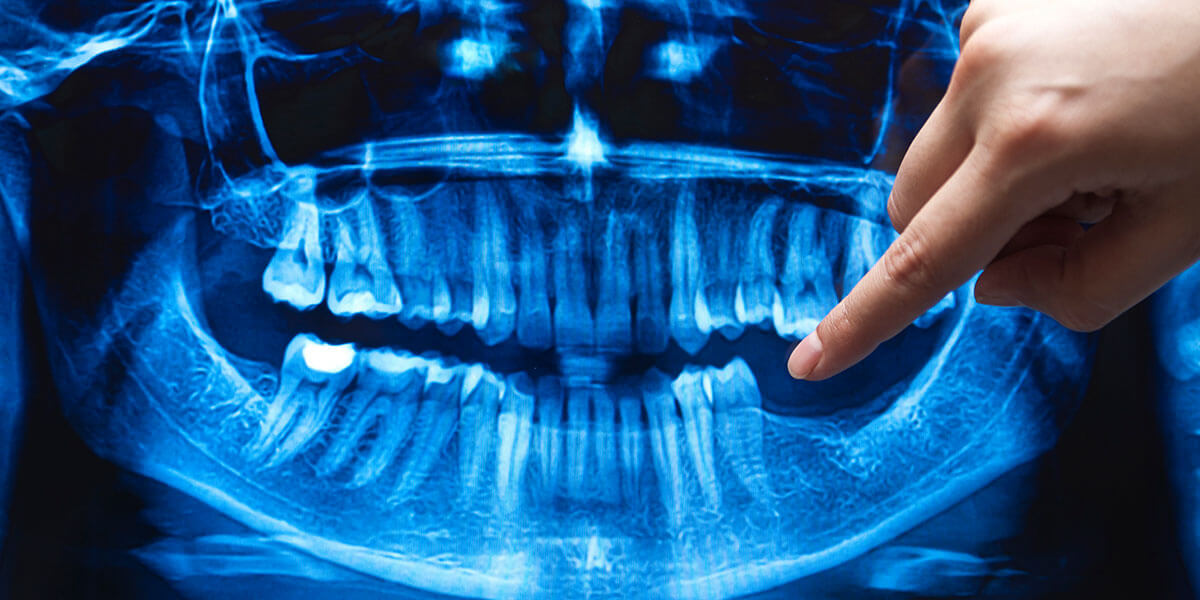 Xray showing missing teeth