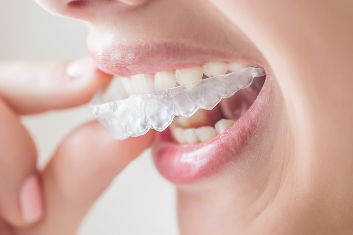 Keeping Your Invisalign Trays Clean Minoli & Vijay DDS